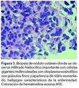 Reticulohistiocitosis multicéntrica.jpg