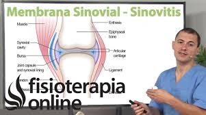 Archivo:Sinovitis de muñeca.jpg