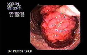 Poliposis familiar.jpg