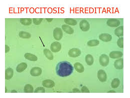 Eliptocis hereditaria.jpg