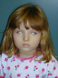 Sindrome de moebius.jpg