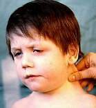 Sindrome de nooman.jpg