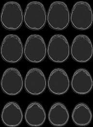 Prolapso del ventric. Morgagni.jpg