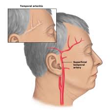 Arteritis-temporal123.jpg