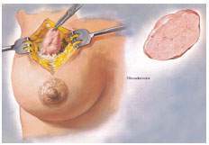 Fibroadenoma.jpg