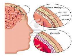 Enfermedad de la meninguitis.jpg