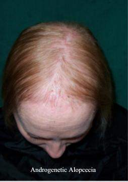 Androgenetic alopecia.jpg