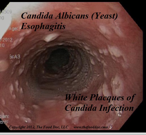 Esofaguitis provocada por infección del hongo Candida Albicans. Candidiasis en el esófago.