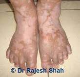 Vitiligo pies.jpeg