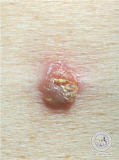 Archivo:Dermis-Acantoma de celulas claras.jpg