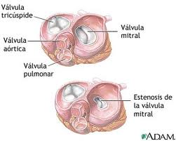 Resultado de imagen para fiebre reumatica