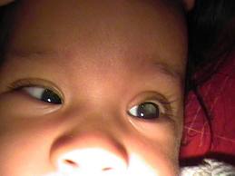 Retinop-de-la-premat 2.jpeg