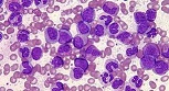Leucemia linfoblástica aguda del adulto.jpg