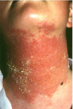 Sindrome de Baboon.JPG