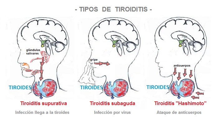 Tiroiditis tratamientos