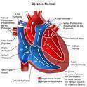 Estenosis aortica.jpg