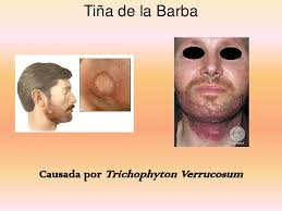 Tiña de la barba.jpg