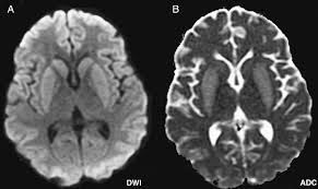 Síndrome de Lance Adams.jpg