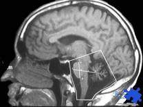 Ataxia cerebelosa aguda.jpg