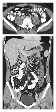 Fiebre papataciFIG2.gifFIG1.gif