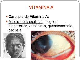 Carencia de vitamina A.jpg