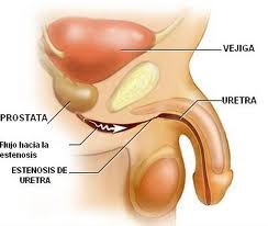 Estenosis uretral

Es el estrechamiento anormal de la uretra
Algunos de los síntomas son:

Sangre en el semen 

Orina Oscura 