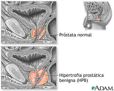 Archivo:Hiperplasia-prostata.jpg