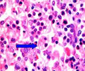 Linfohistiocitosis hemofagocítica.jpeg