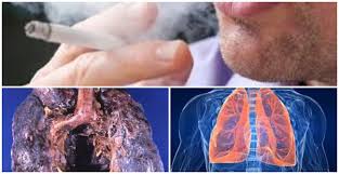 Archivo:Enfisema pulmonal hemorragico.jpg