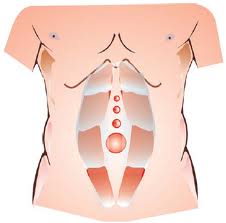 Hernias Epigástricas.jpeg