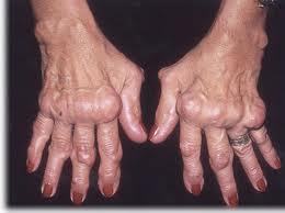 Artritis Reumatoidea.jpg