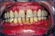 Periodontitisjcmzllo4.jpeg