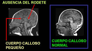 Archivo:Agenesia del Cuerpo Calloso.jpg