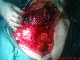 Síndrome hemorrág. índice.jpeg