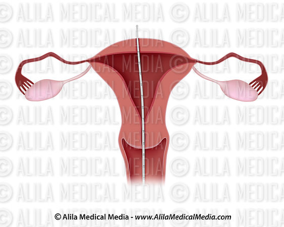 Archivo:Utero Perforado.jpg