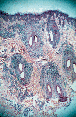 Síndrome de Graham-Little.gif