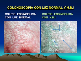 Colitis eosinofilica.jpg