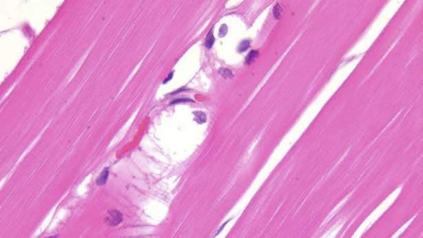 Archivo:Enfermedad de McArdle.jpg