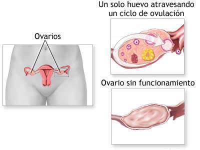 Archivo:Hipofunción ovárica.jpg