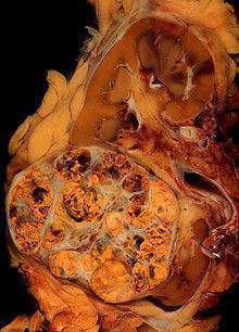 Carcinoma renal - EcuRed