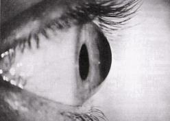 Trasplante de Córnea.JPG