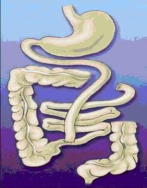 By Pass Yeyuno Ileal.jpg