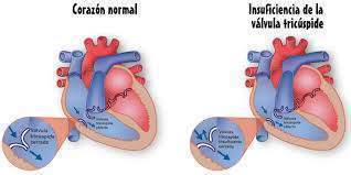 Archivo:Insuficiencia de la válvula tricuspídia.jpg