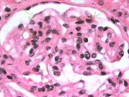 Síndrome nefrótico en niños.jpeg