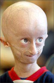 Progeria.jpg