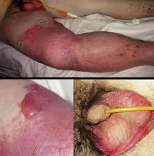 Síndrome de shock tóxico.jpeg