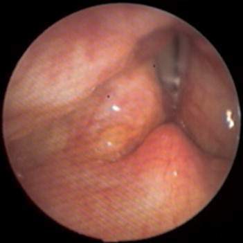 Archivo:Lupus laríngeo gr3.jpg