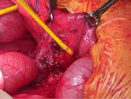 Cáncer del páncrea.jpeg