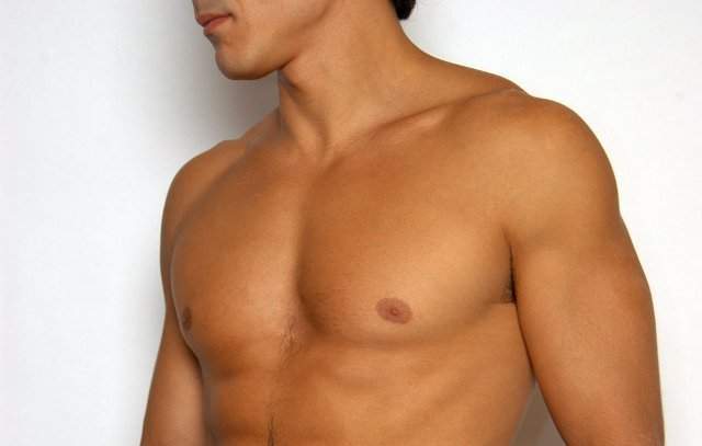 Archivo:Ginecomastia.jpg