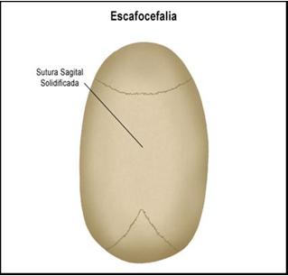 Escafocefalia.JPG